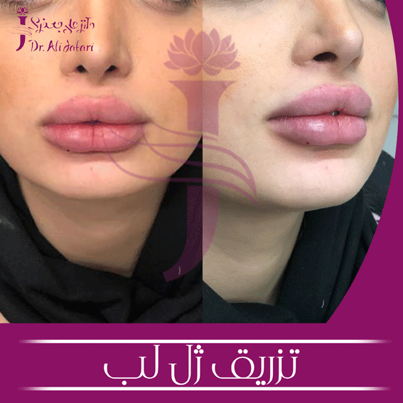تزریق ژل لب مطب دکتر جعفری (1)