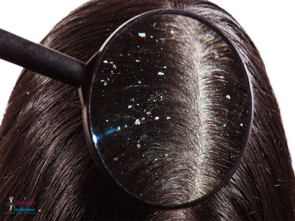 روش های مراقبت از مو های چرب و روغنی – راهکارهای ساده برای داشتن موهایی سالم
