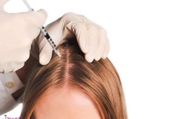 مزوتراپی موها و مدیریت ریزش مو با مزوتراپی