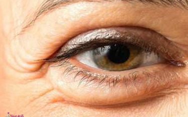 پف دور چشم و درمان قطعی آن با مزوتراپی، پلاسماجت و تزریق پی آر پی