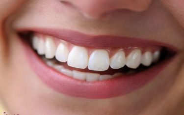 زیبایی دندان – 11 روش زیباسازی دندان ها (ایمپلنت، لمینت، روکش و …)