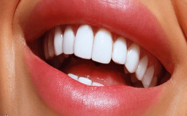 لمینت دندان و انواع لمینت ها و کاربرد آن برای زیبایی دندان