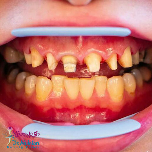 لمینت دندان و انواع لمینت ها و کاربرد آن برای زیبایی دندان 