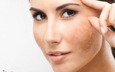 لک ها و تیرگی های پوست (علل ایجاد و روش های درمان لک ها در نواحی مختلف بدن)