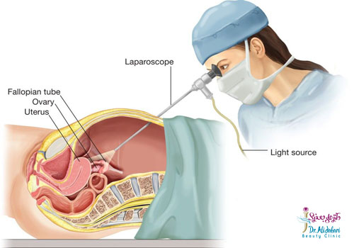 لاپاراسکوپی چیست؟موارد استفاده از جراحی لاپاراسکوپی و لاپاراسکوپی لاغری