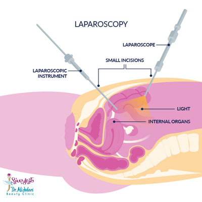 لاپاراسکوپی چیست؟موارد استفاده از جراحی لاپاراسکوپی و لاپاراسکوپی لاغری