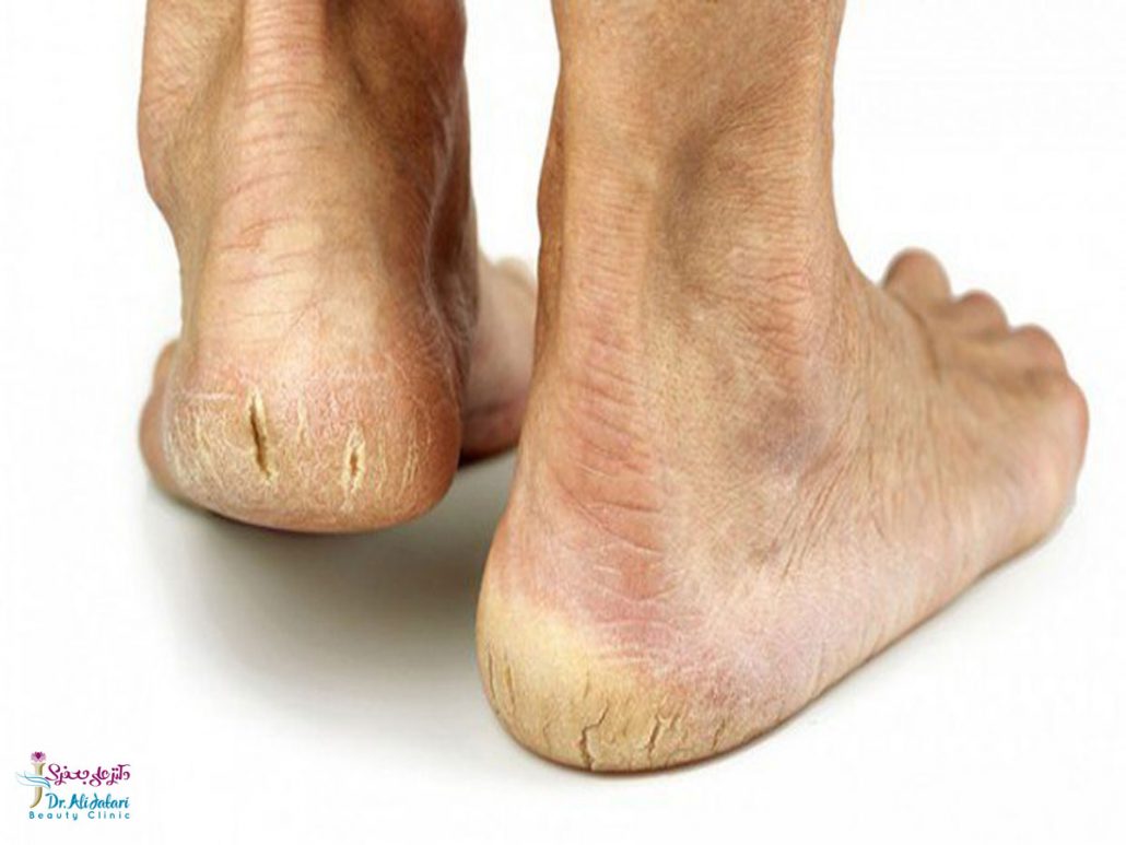 ترک کف پا چیست و چگونه می‌توان ترک‌خوردگی کف پا را درمان کرد؟