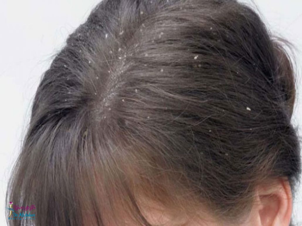 مراقبت از موهای خشک _ 5 راه آسان جهت درمان پوست سر و موی خشک