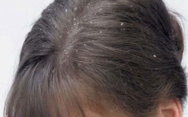 مراقبت از موهای خشک _ 5 راه آسان جهت درمان پوست سر و موی خشک