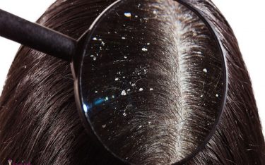 روش های مراقبت از مو های چرب و روغنی – راهکارهای ساده برای داشتن موهایی سالم