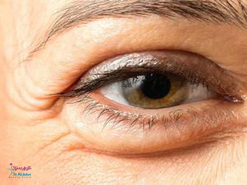 پف دور چشم و درمان قطعی آن با مزوتراپی، پلاسماجت و تزریق پی آر پی