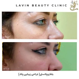 بلفاروپلاستی