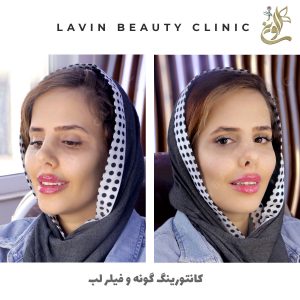 تزریق گونه