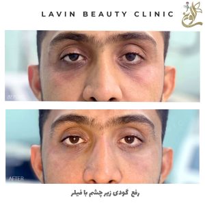 تزریق فیلر زیر چشم