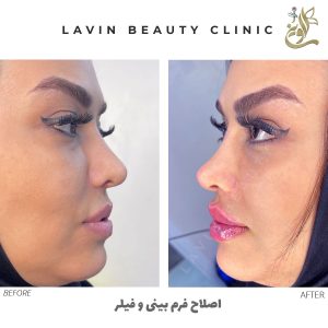 اصلاح فرم بینی