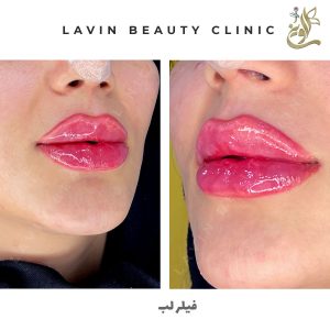 تزریق ژل لب