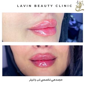 تزریق ژل لب