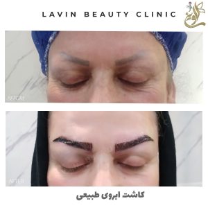 کاشت ابروی طبیعی