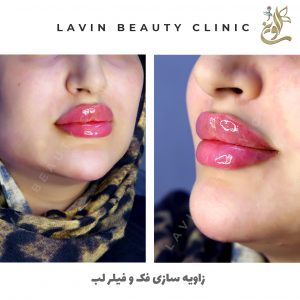 تزریق ژل لب