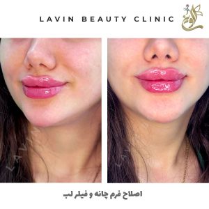 تزریق ژل لب