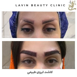 کاشت ابرو