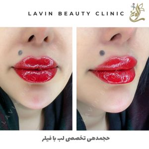 تزریق ژل لب
