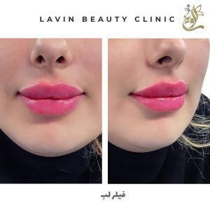 تزریق ژل لب