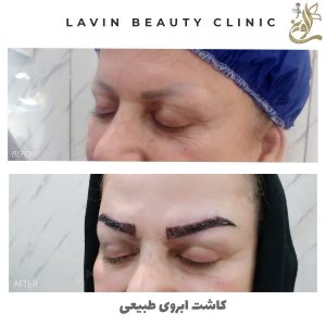 کاشت ابروی طبیعی