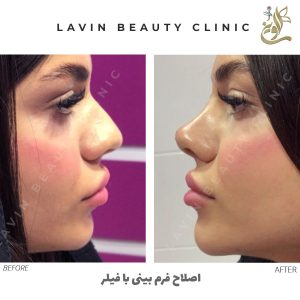 اصلاح فرم بینی