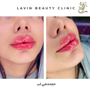 تزریق ژل لب