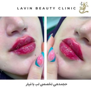 تزریق ژل لب