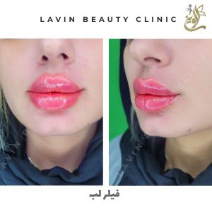 تزریق ژل لب