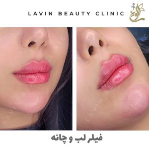 تزریق ژل لب