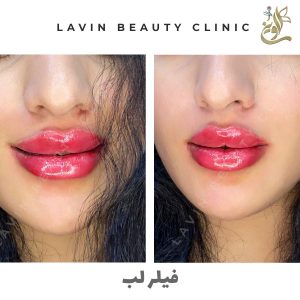 تزریق ژل لب