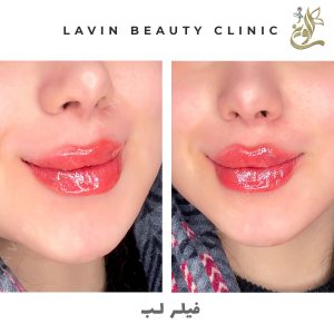 تزریق ژل لب