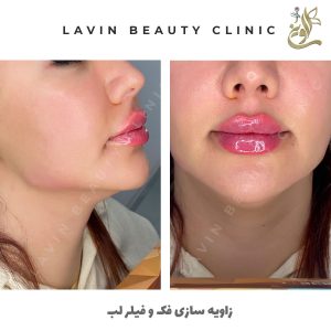 تزریق ژل لب