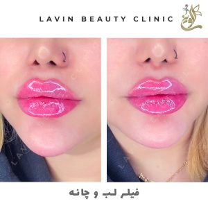 تزریق ژل لب
