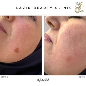 خالبرداری بدون درد