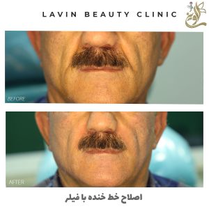 تزریق فیلر خط خنده