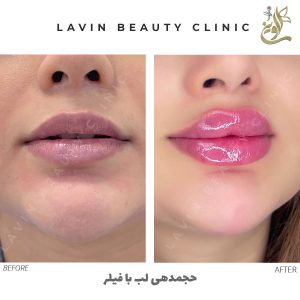 تزریق ژل لب