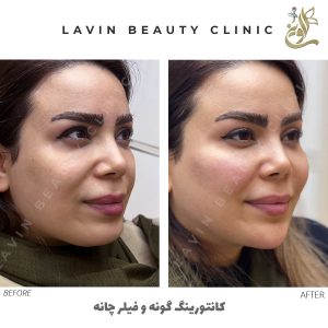 تزریق فیلر گونه