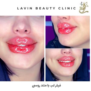 تزریق ژل لب
