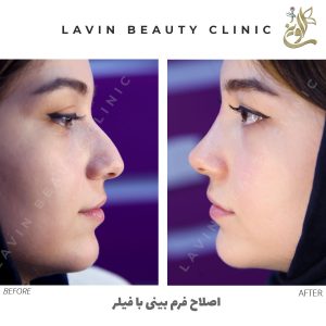 اصلاح فرم بینی