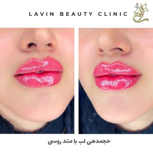 تزریق ژل لب
