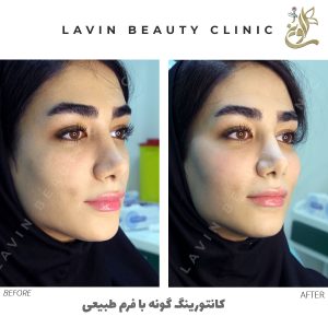 تزریق فیلر گونه