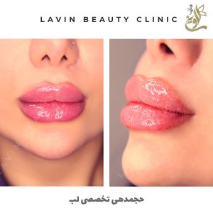 تزریق فیلر لب