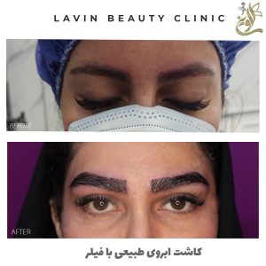 کاشت ابروی طبیعی