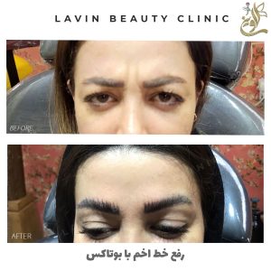تزریق بوتاکس