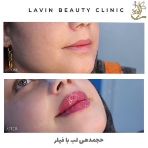 تزریق فیلر لب