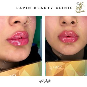 تزریق فیلر لب